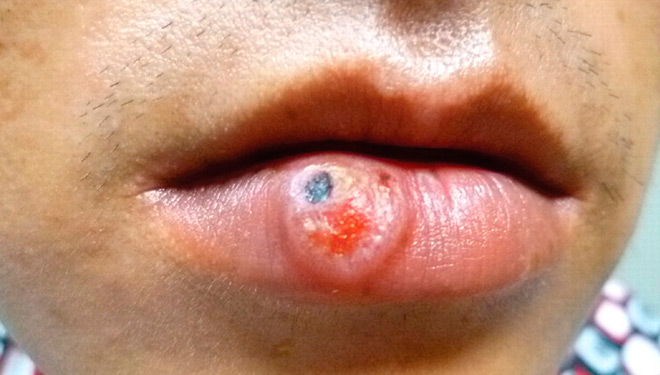 Сифилис на губах