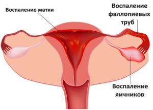 Воспалительные процессы у женщин