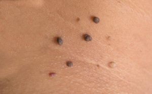 Папилломы на теле и на коже: причины, симптомы, виды образований