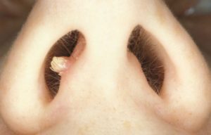 Если вас беспокоит папиллома в носу, то эта статья будет вам полезна. В ней вы найдете информацию о видах, симптомах и методах диагностики новообразований в носу. А также, схемы лечения в домашних условиях препаратами и методы удаления папиллом.