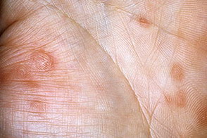 Характер сыпи при сифилисе thumbnail