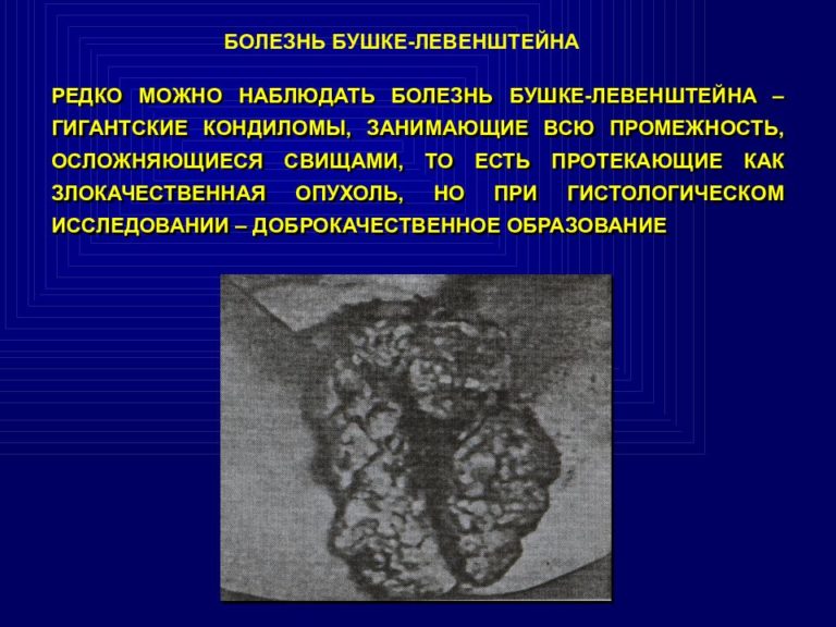 Гигантская кондилома бушке левенштейна фото