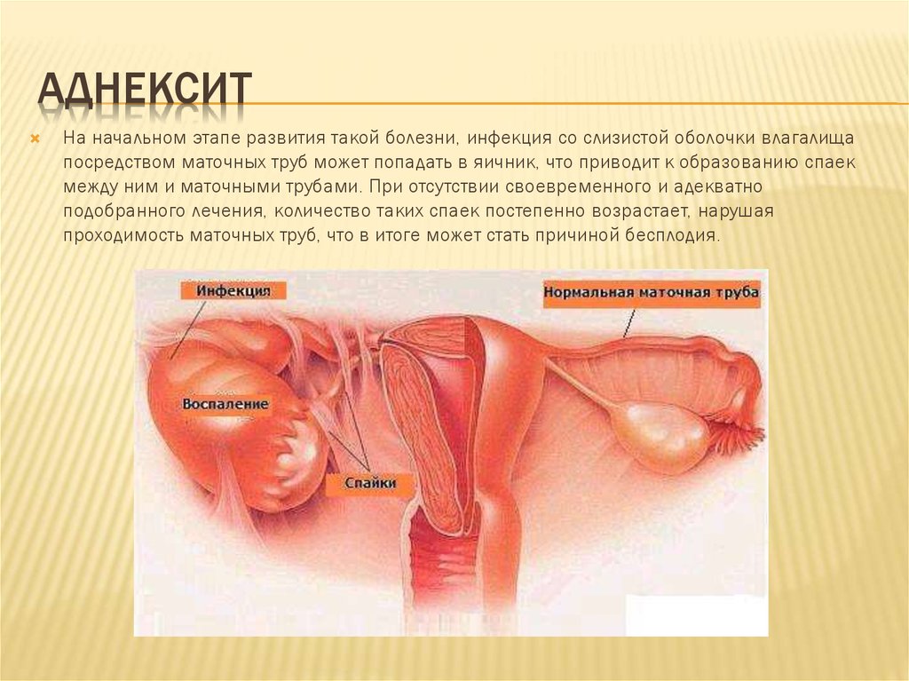 Схема лечения хронического сальпингоофорита