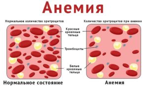 Общий анализ крови при вич инфекции показатели лимфоцитов thumbnail