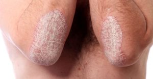 Белая сыпь на половых губах женщины thumbnail