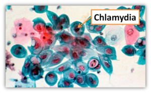 Chlamydia trachomatis что это за болезнь thumbnail
