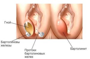 Специфические воспаления женских органов thumbnail