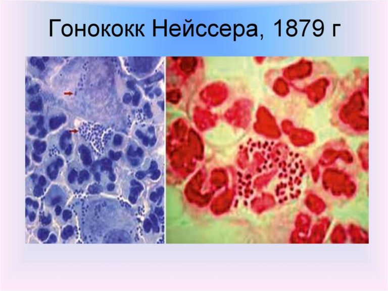 Как берут мазок у женщин фото