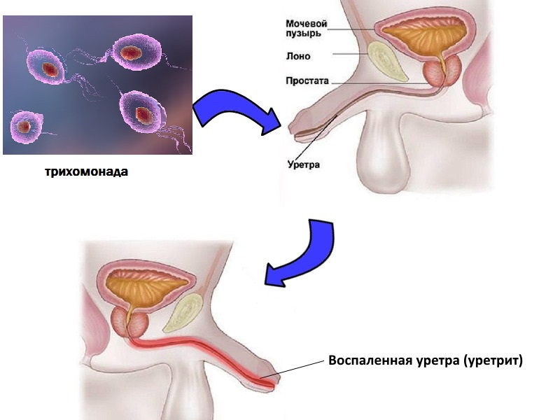 Уретрит схемы лечения